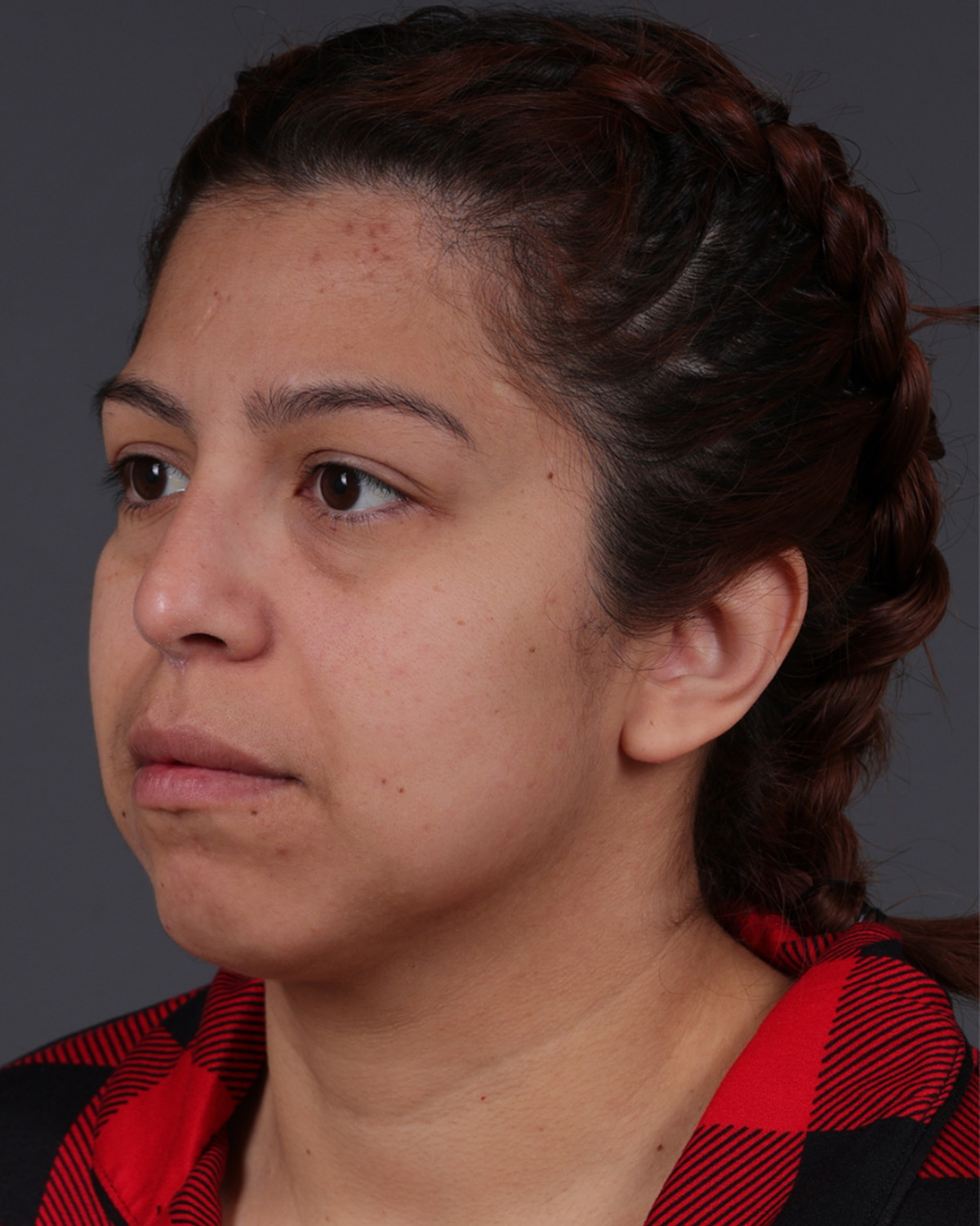 Fat Grafting Before & After Gallery - Patient 397263 - Image 5