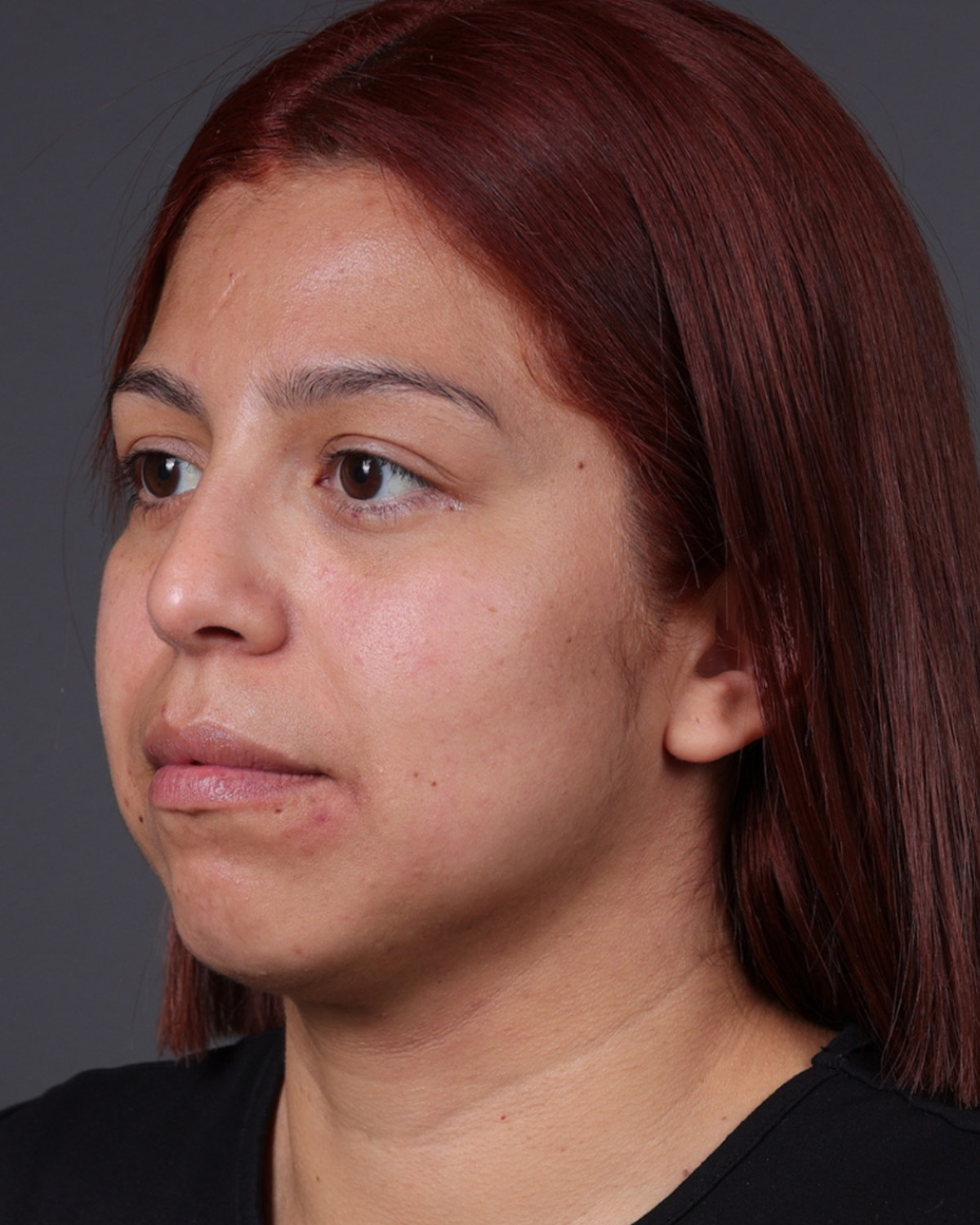 Fat Grafting Before & After Gallery - Patient 397263 - Image 6
