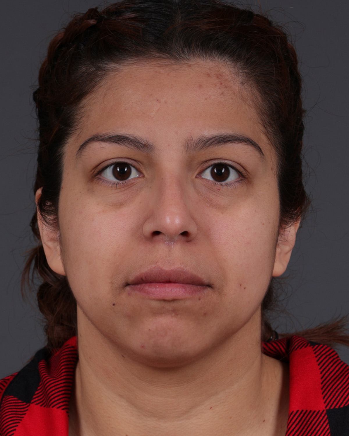 Fat Grafting Before & After Gallery - Patient 397263 - Image 1