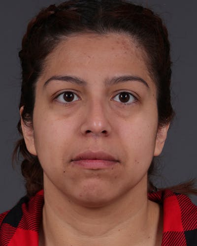 Fat Grafting Before & After Gallery - Patient 397263 - Image 1