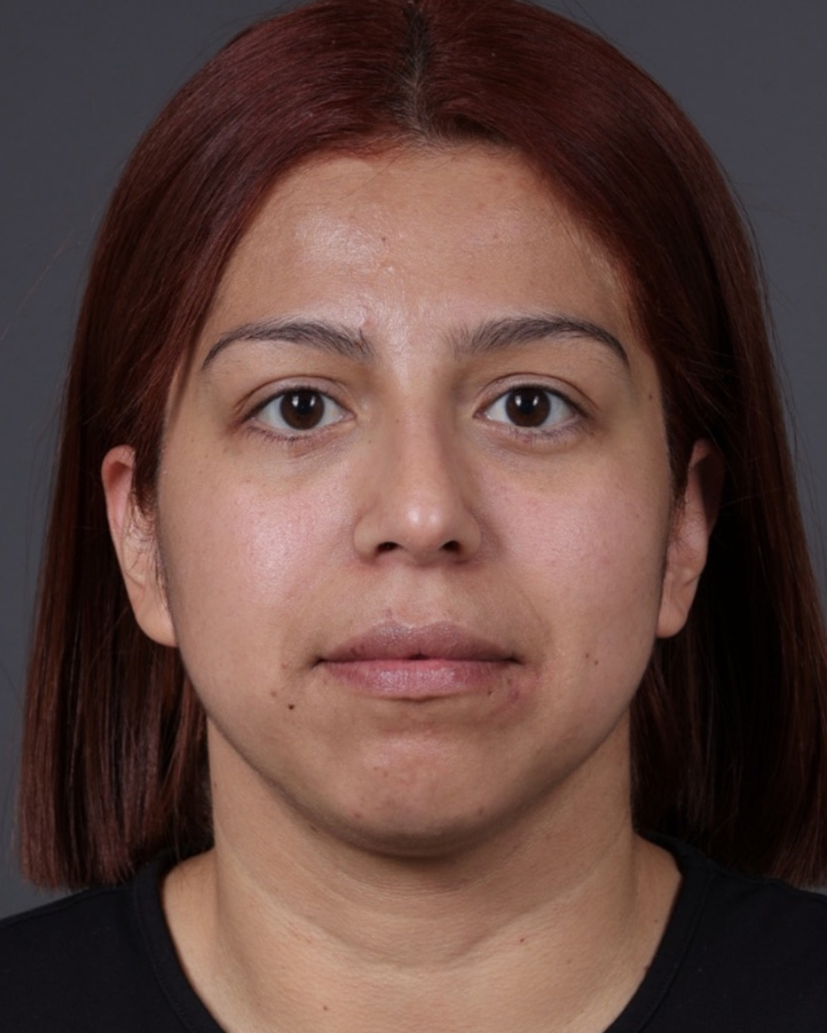 Fat Grafting Before & After Gallery - Patient 397263 - Image 2