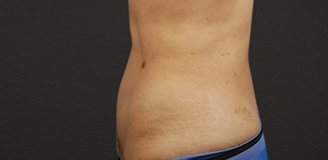 Liposuction Before & After Gallery - Patient 330875 - Image 2