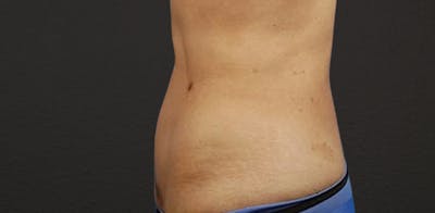 Liposuction Before & After Gallery - Patient 330875 - Image 2