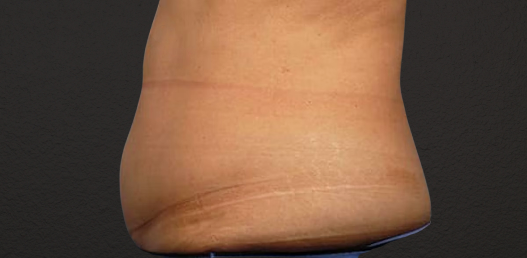Liposuction Before & After Gallery - Patient 330875 - Image 1