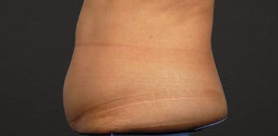 Liposuction Before & After Gallery - Patient 330875 - Image 1