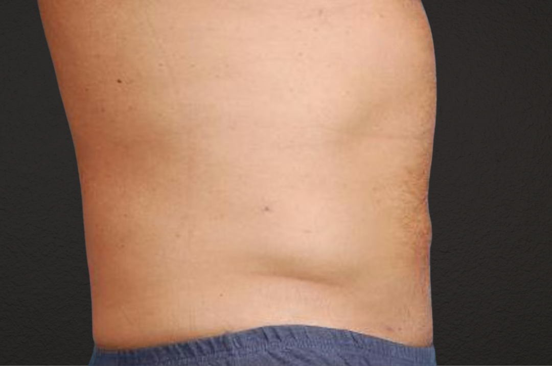 Liposuction Before & After Gallery - Patient 135889 - Image 2