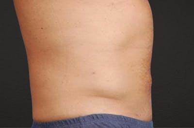 Liposuction Before & After Gallery - Patient 135889 - Image 2