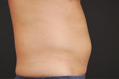 Liposuction Before & After Gallery - Patient 135889 - Image 1