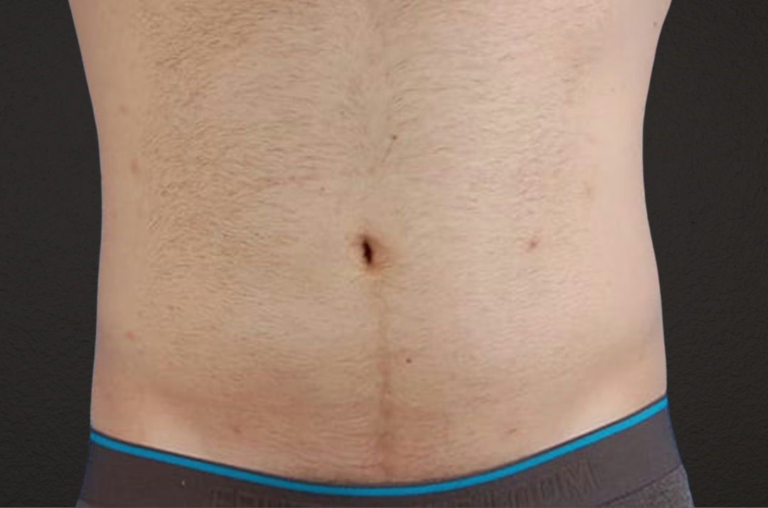 Liposuction Before & After Gallery - Patient 333626 - Image 2