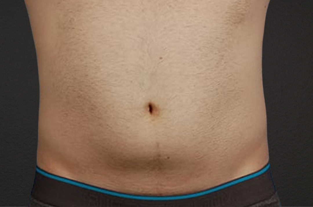 Liposuction Before & After Gallery - Patient 333626 - Image 1