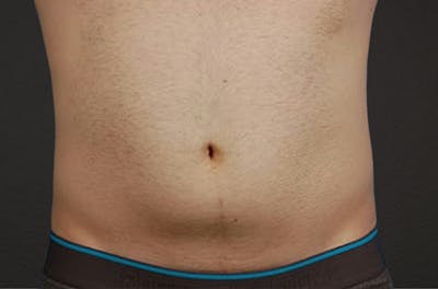 Liposuction Before & After Gallery - Patient 333626 - Image 1