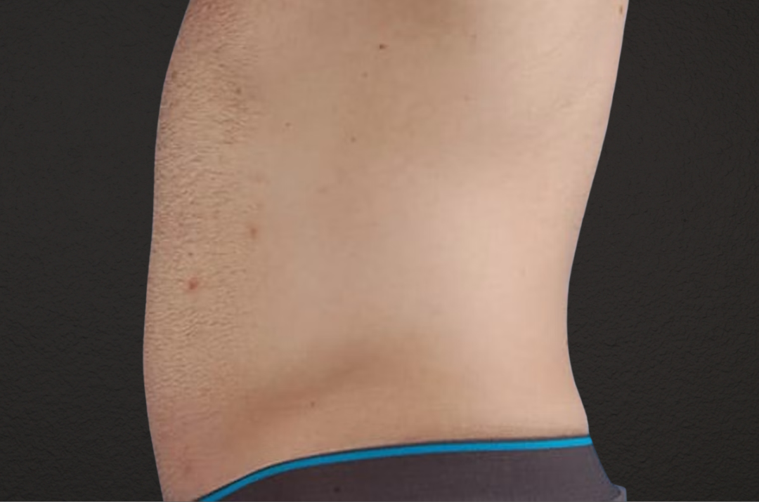 Liposuction Before & After Gallery - Patient 333626 - Image 4