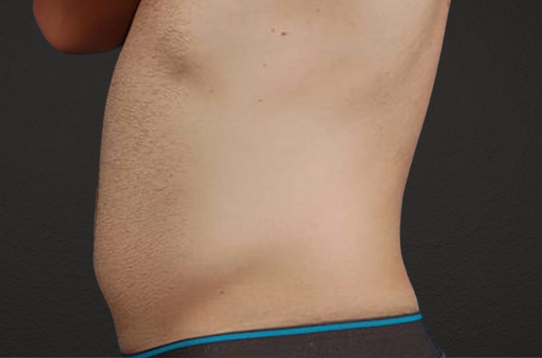 Liposuction Before & After Gallery - Patient 333626 - Image 3