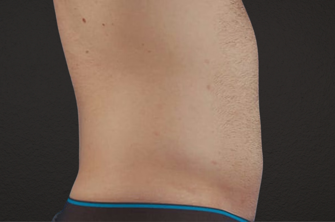 Liposuction Before & After Gallery - Patient 333626 - Image 6