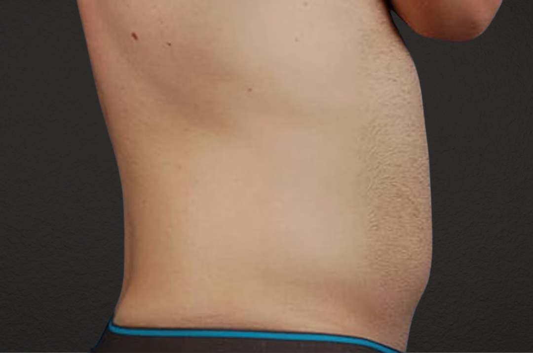 Liposuction Before & After Gallery - Patient 333626 - Image 5