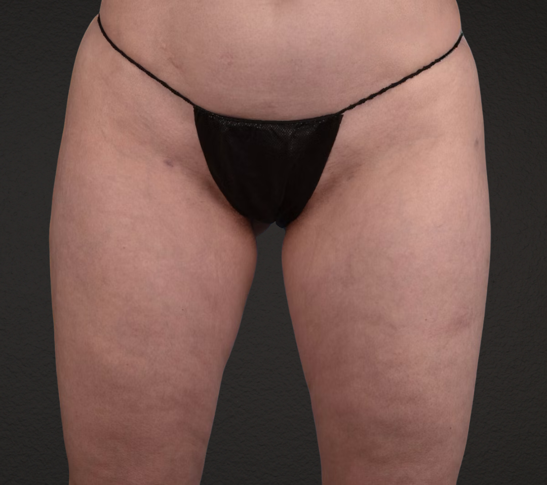 Liposuction Before & After Gallery - Patient 464332 - Image 2