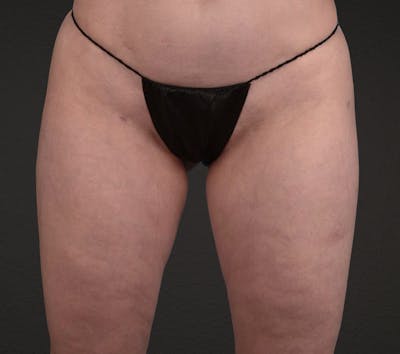 Liposuction Before & After Gallery - Patient 464332 - Image 2