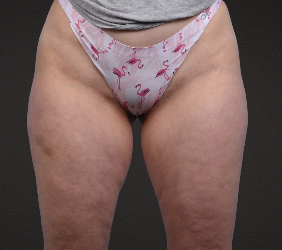 Liposuction Before & After Gallery - Patient 464332 - Image 1