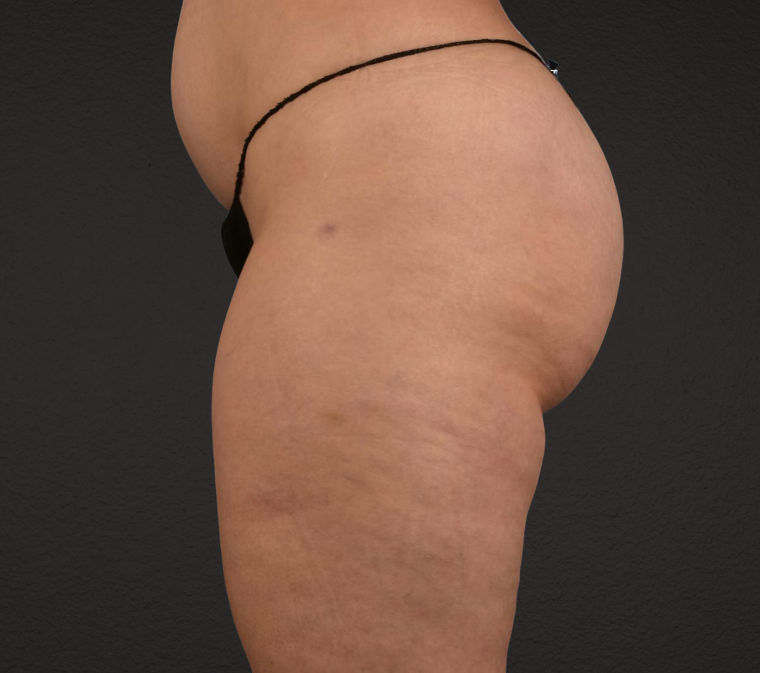 Liposuction Before & After Gallery - Patient 464332 - Image 4