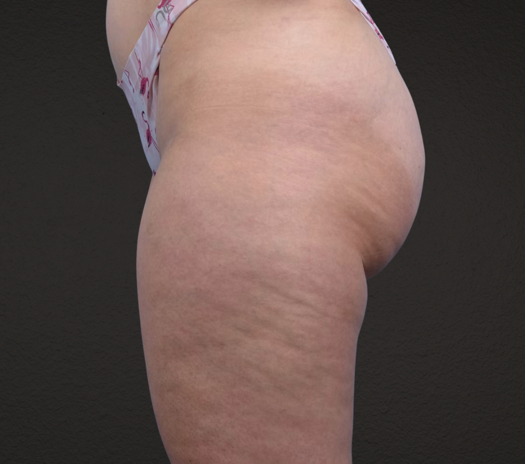 Liposuction Before & After Gallery - Patient 464332 - Image 3