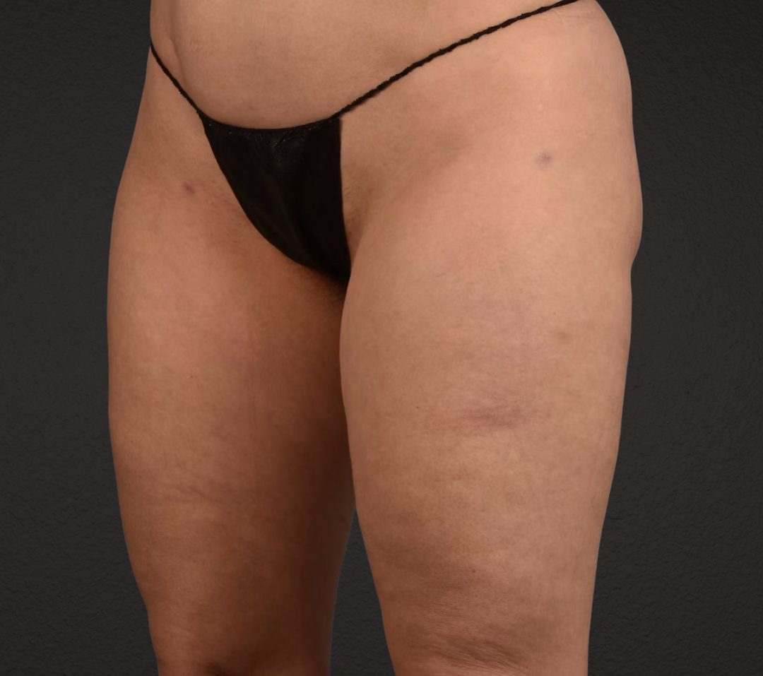 Liposuction Before & After Gallery - Patient 464332 - Image 6