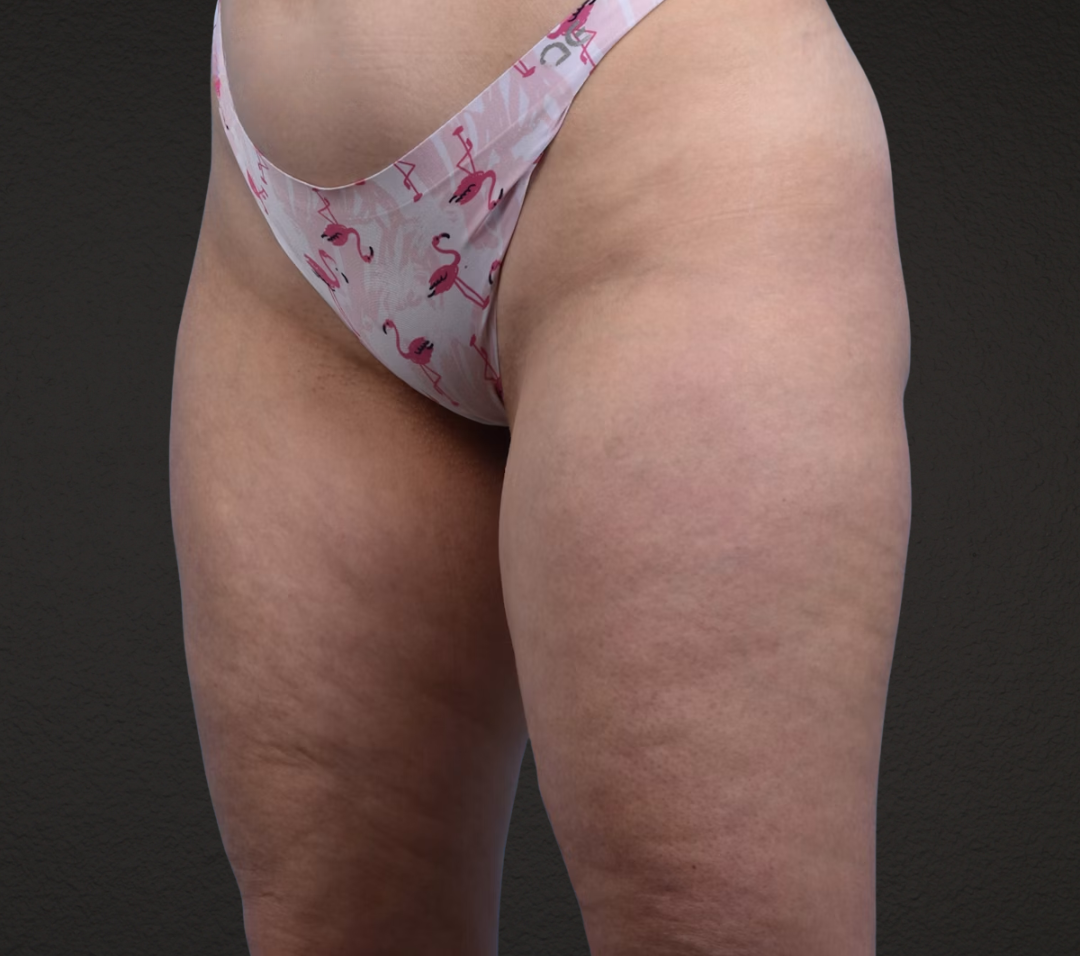 Liposuction Before & After Gallery - Patient 464332 - Image 5