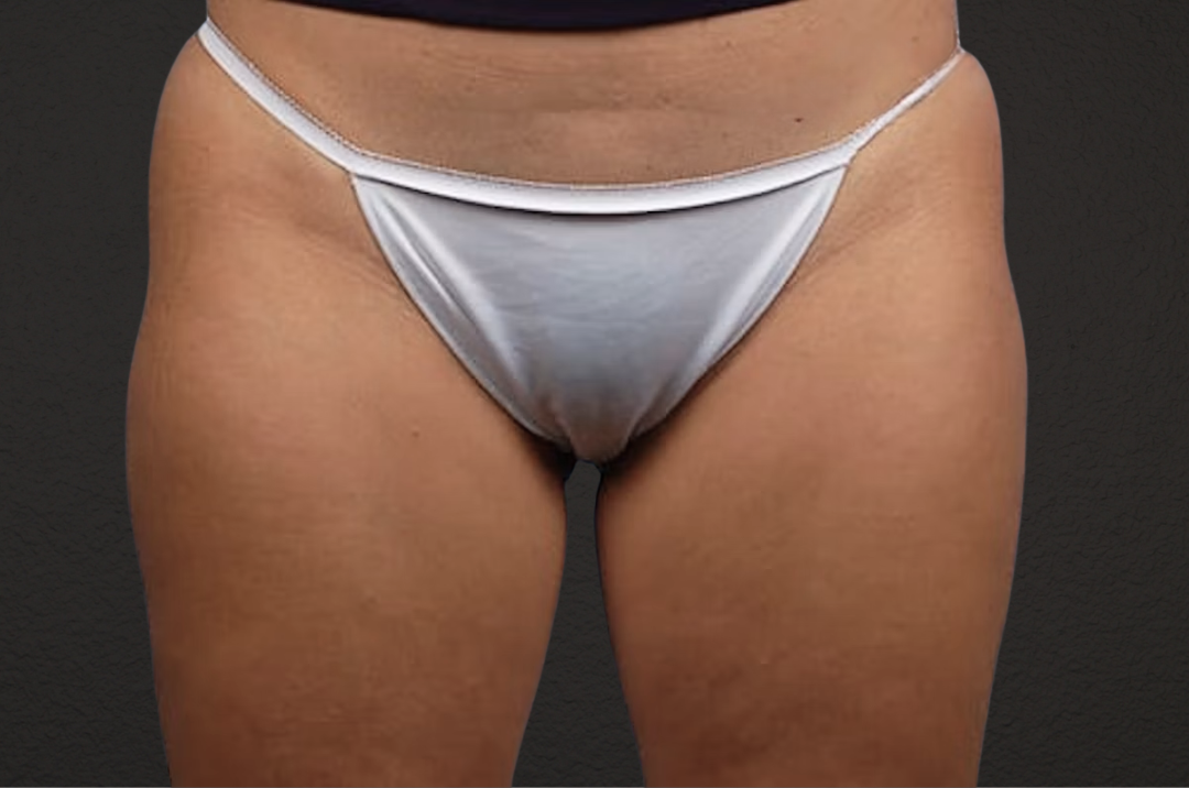 Liposuction Before & After Gallery - Patient 303157 - Image 2