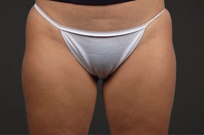 Liposuction Before & After Gallery - Patient 303157 - Image 2