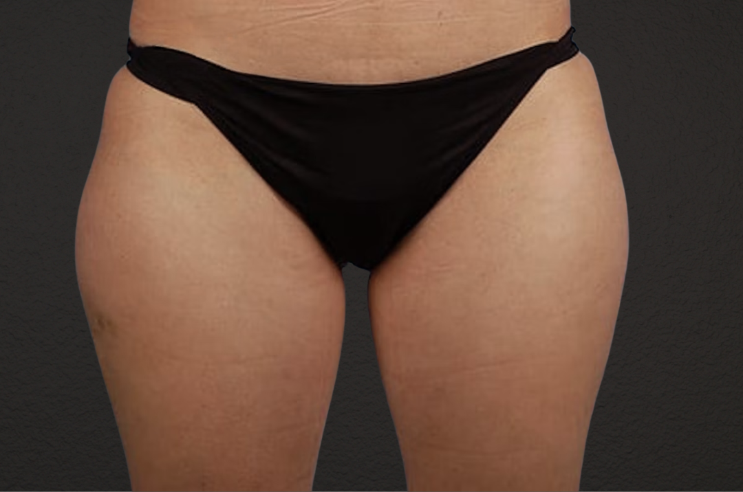 Liposuction Before & After Gallery - Patient 303157 - Image 1