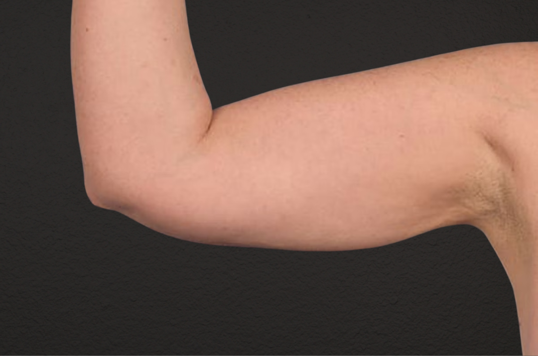Liposuction Before & After Gallery - Patient 329177 - Image 2