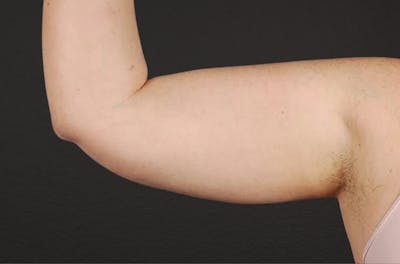 Liposuction Before & After Gallery - Patient 329177 - Image 1