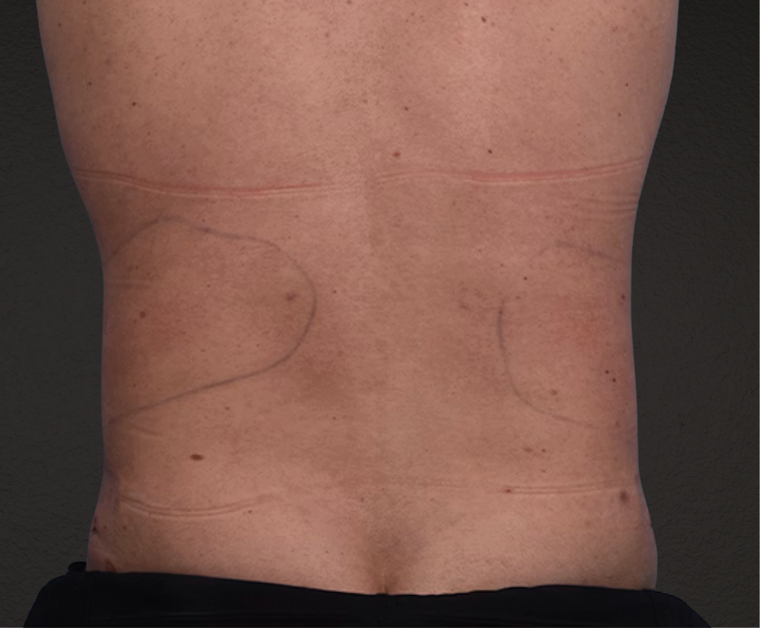 Liposuction Before & After Gallery - Patient 267185 - Image 8