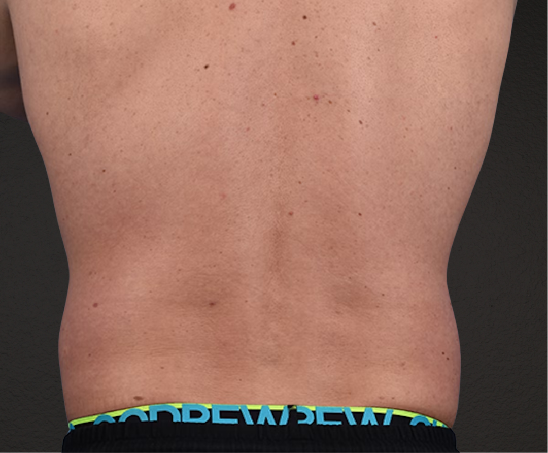 Liposuction Before & After Gallery - Patient 267185 - Image 7