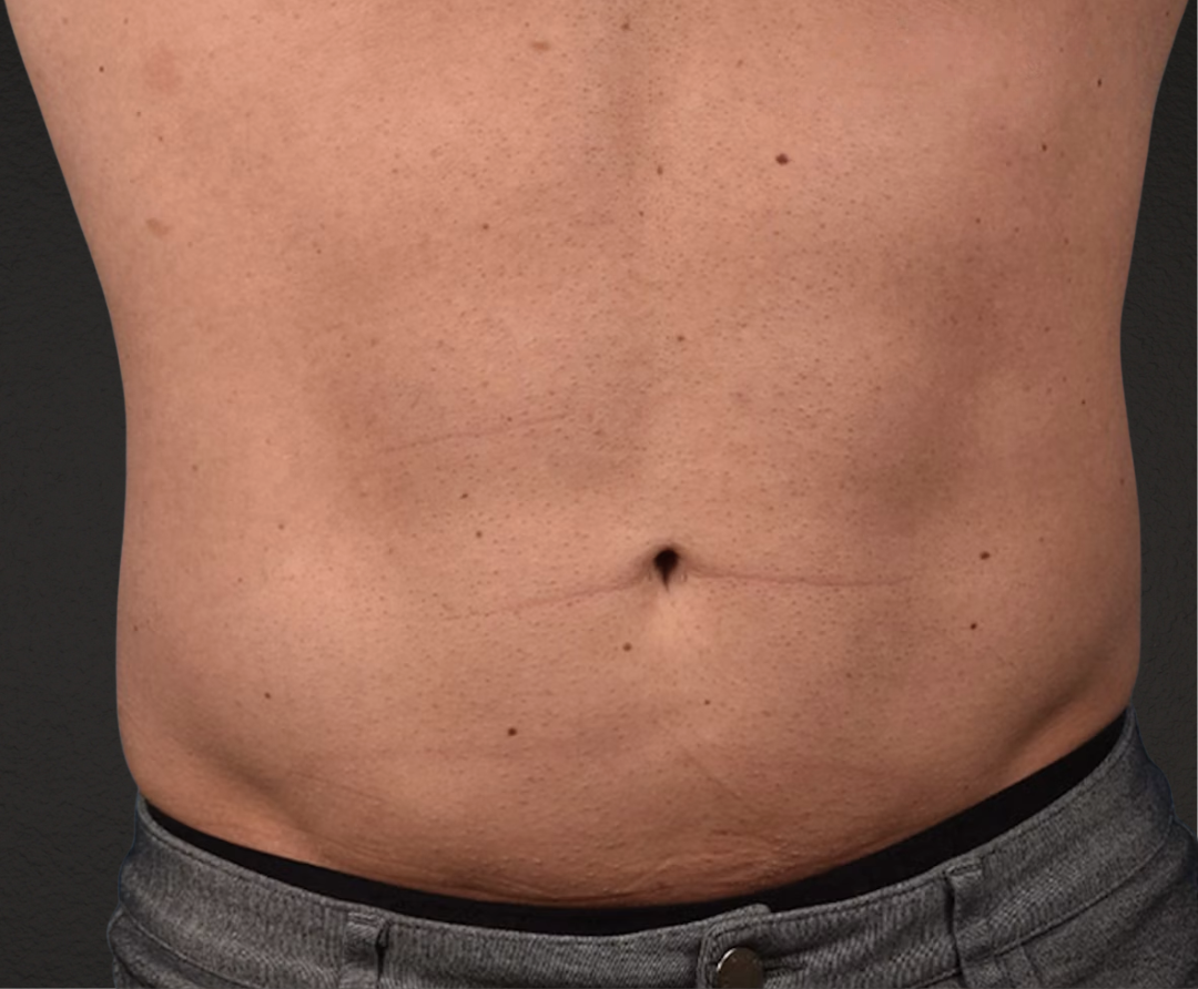 Liposuction Before & After Gallery - Patient 267185 - Image 2
