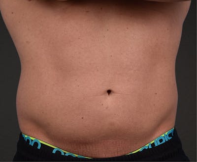 Liposuction Before & After Gallery - Patient 267185 - Image 1
