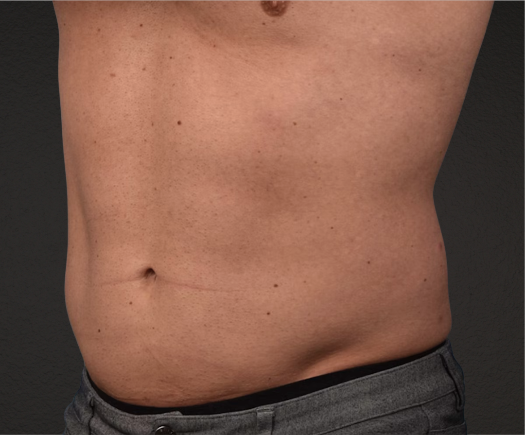 Liposuction Before & After Gallery - Patient 267185 - Image 4