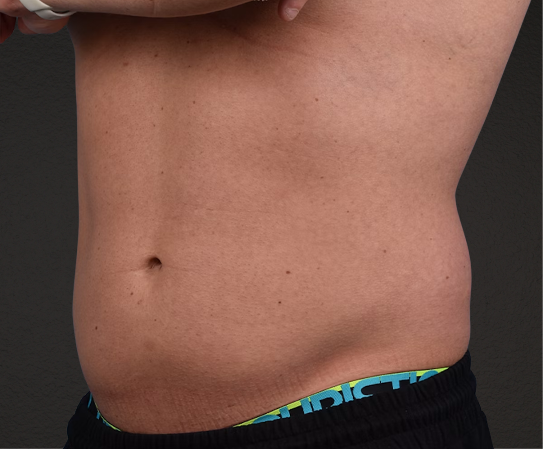 Liposuction Before & After Gallery - Patient 267185 - Image 3