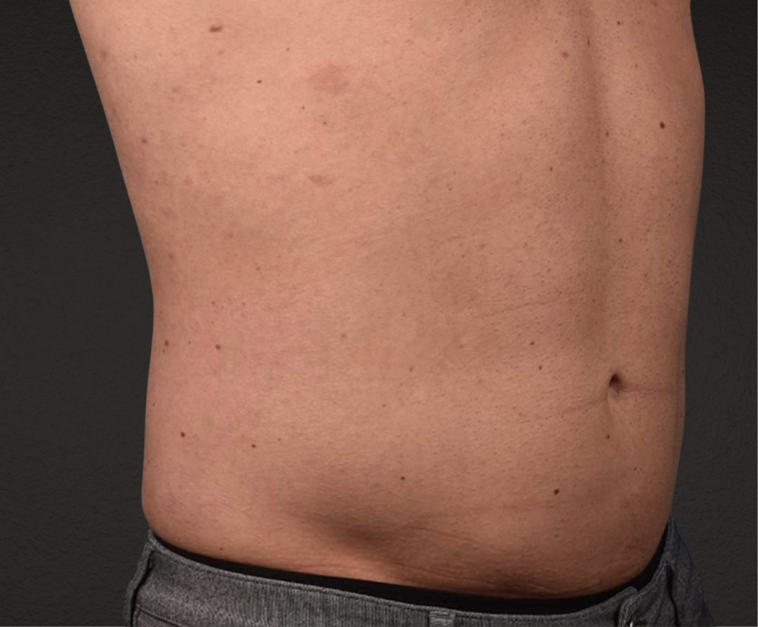 Liposuction Before & After Gallery - Patient 267185 - Image 6