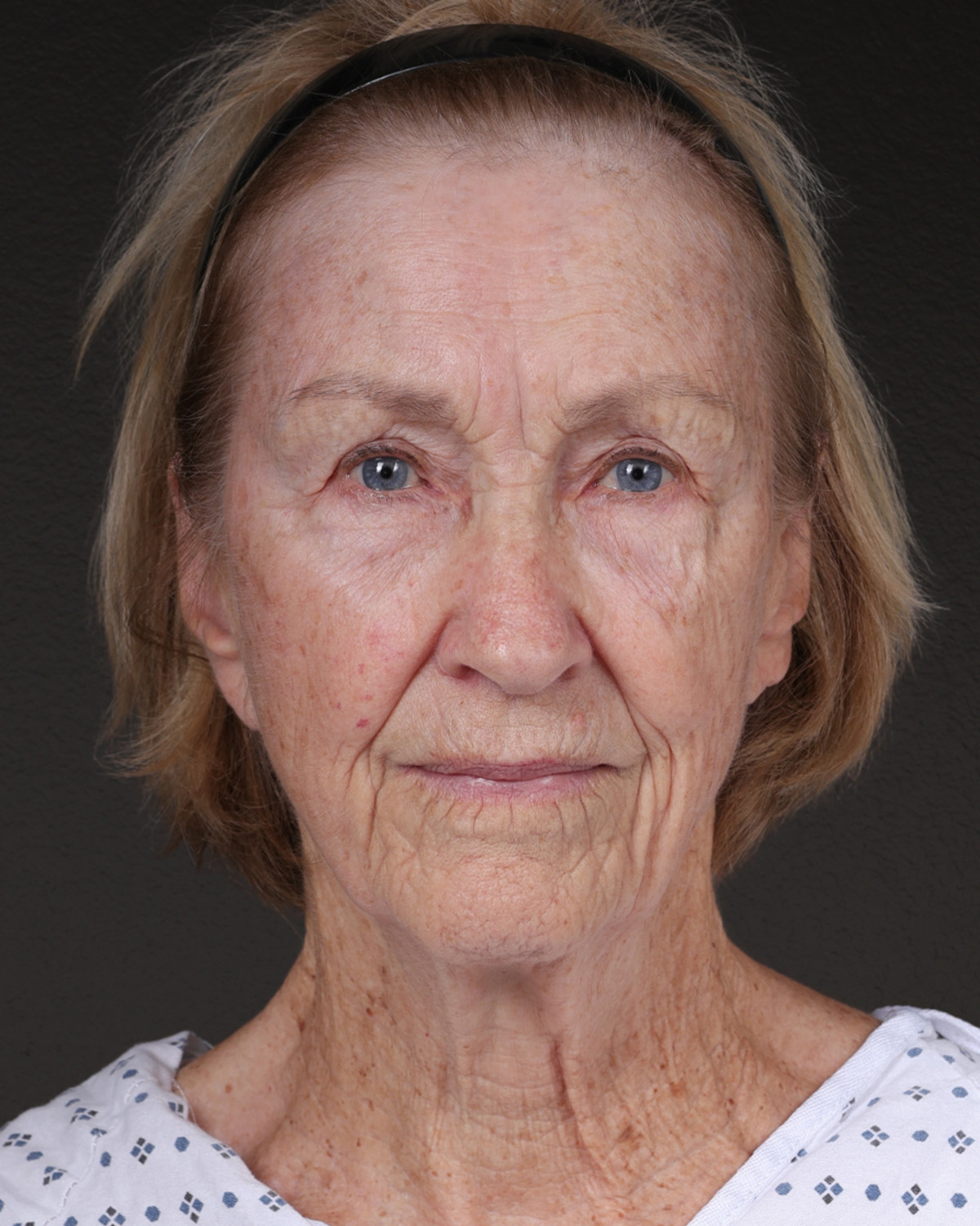 Fat Grafting Before & After Gallery - Patient 351077 - Image 1