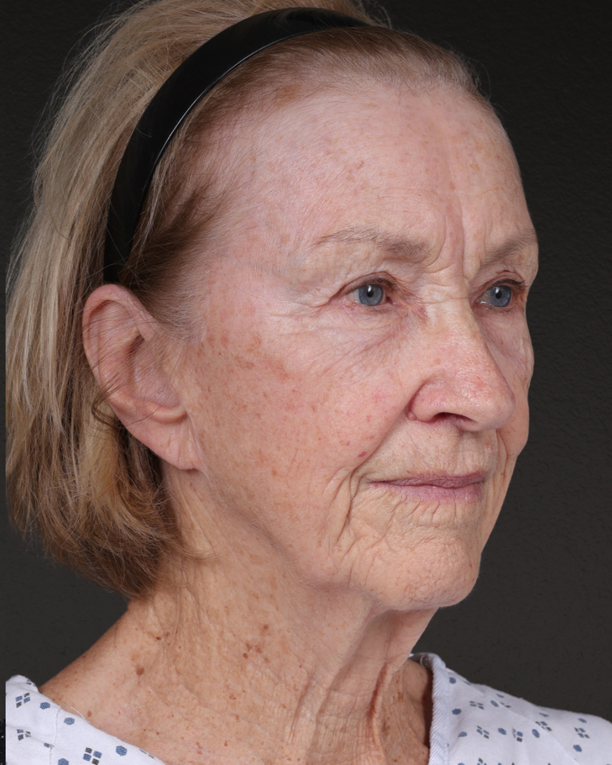 Fat Grafting Before & After Gallery - Patient 351077 - Image 3