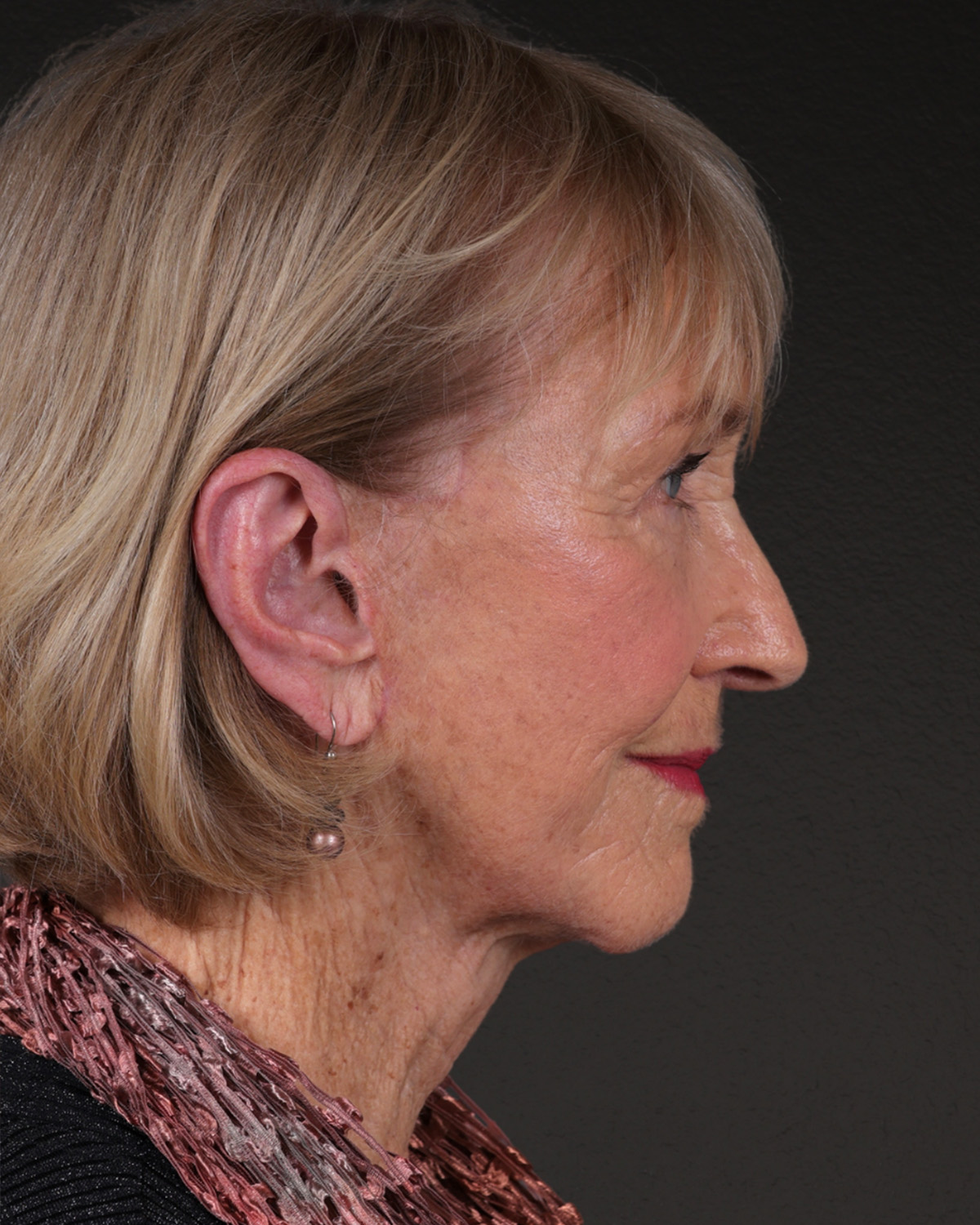 Fat Grafting Before & After Gallery - Patient 351077 - Image 6