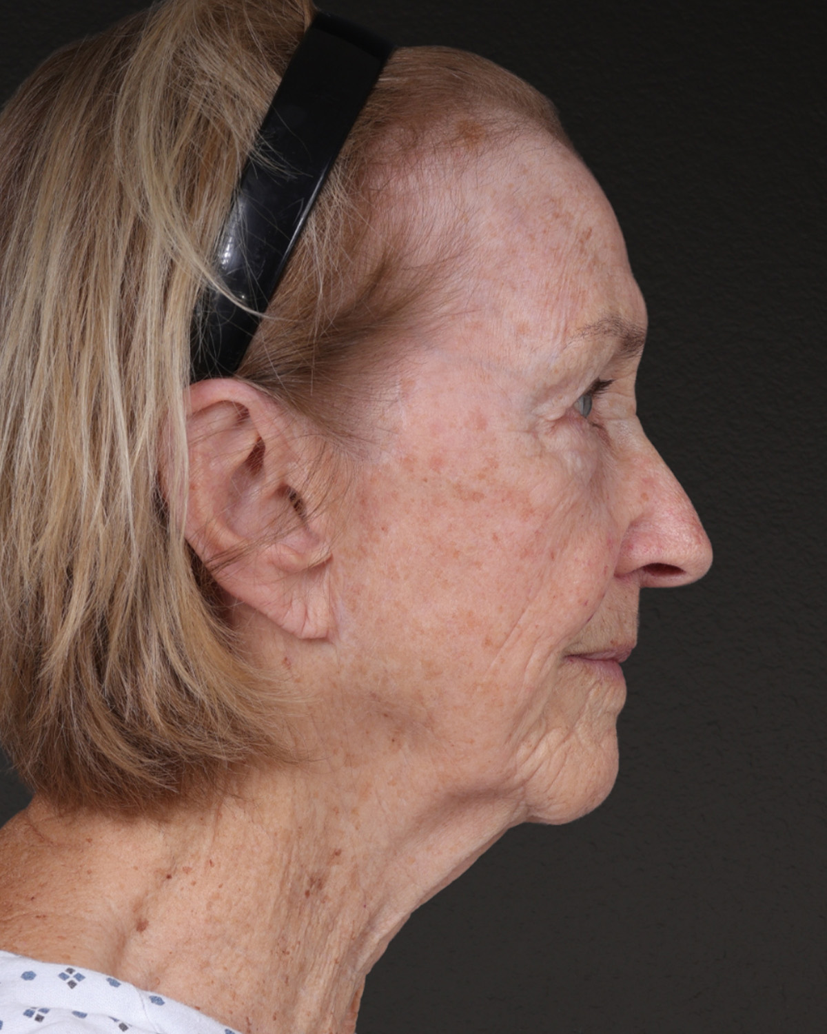 Fat Grafting Before & After Gallery - Patient 351077 - Image 5