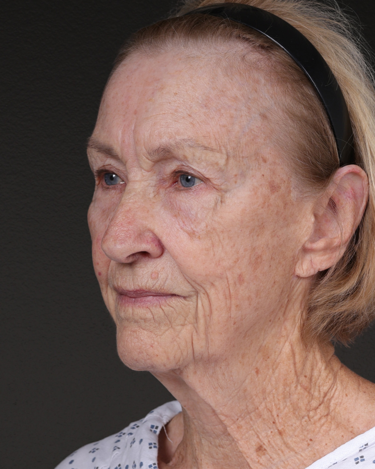 Fat Grafting Before & After Gallery - Patient 351077 - Image 7