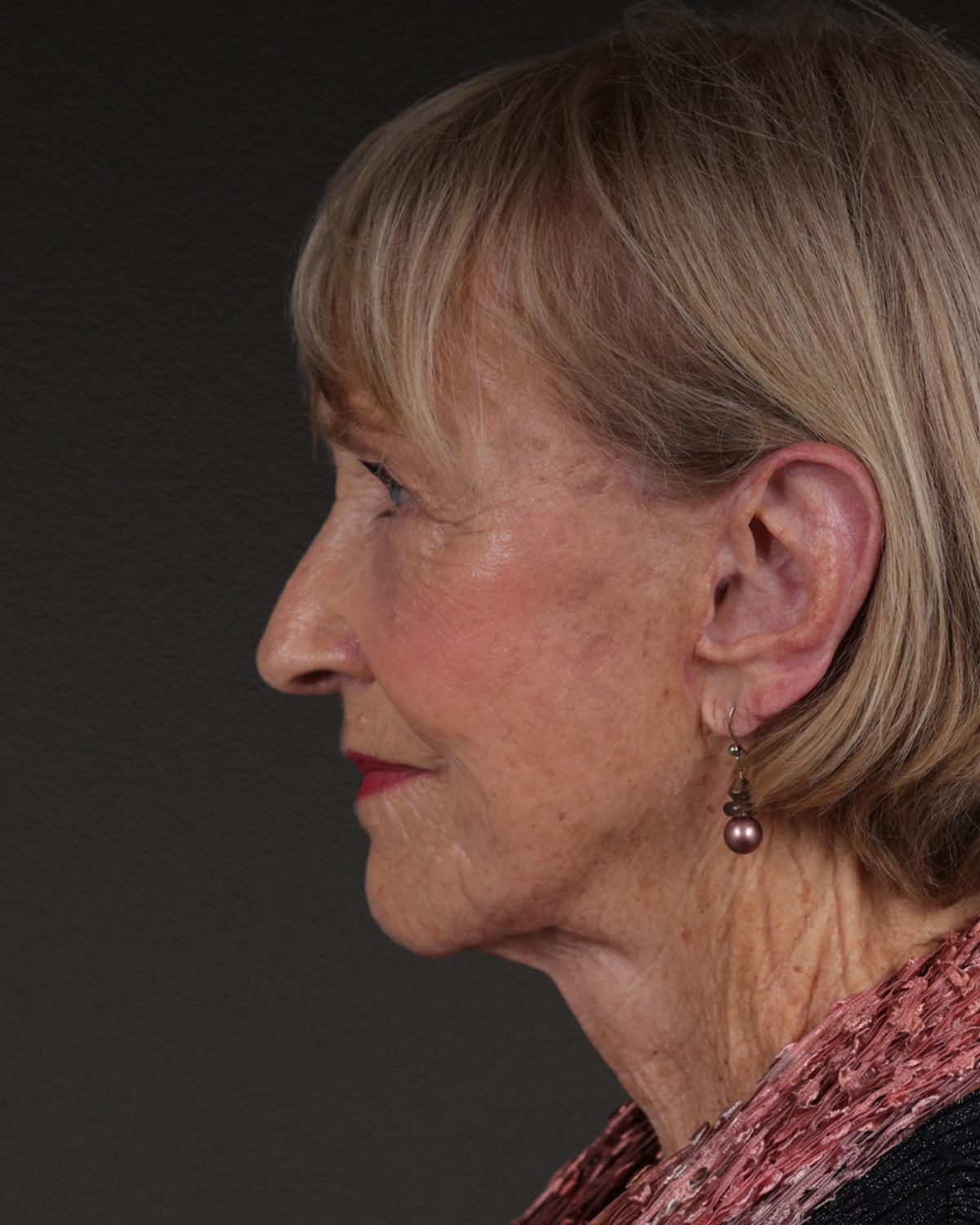 Fat Grafting Before & After Gallery - Patient 351077 - Image 10