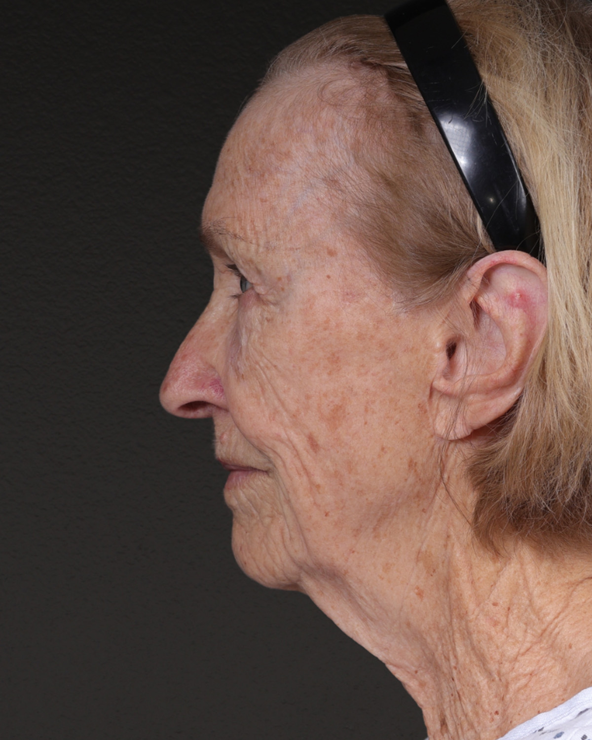 Fat Grafting Before & After Gallery - Patient 351077 - Image 9