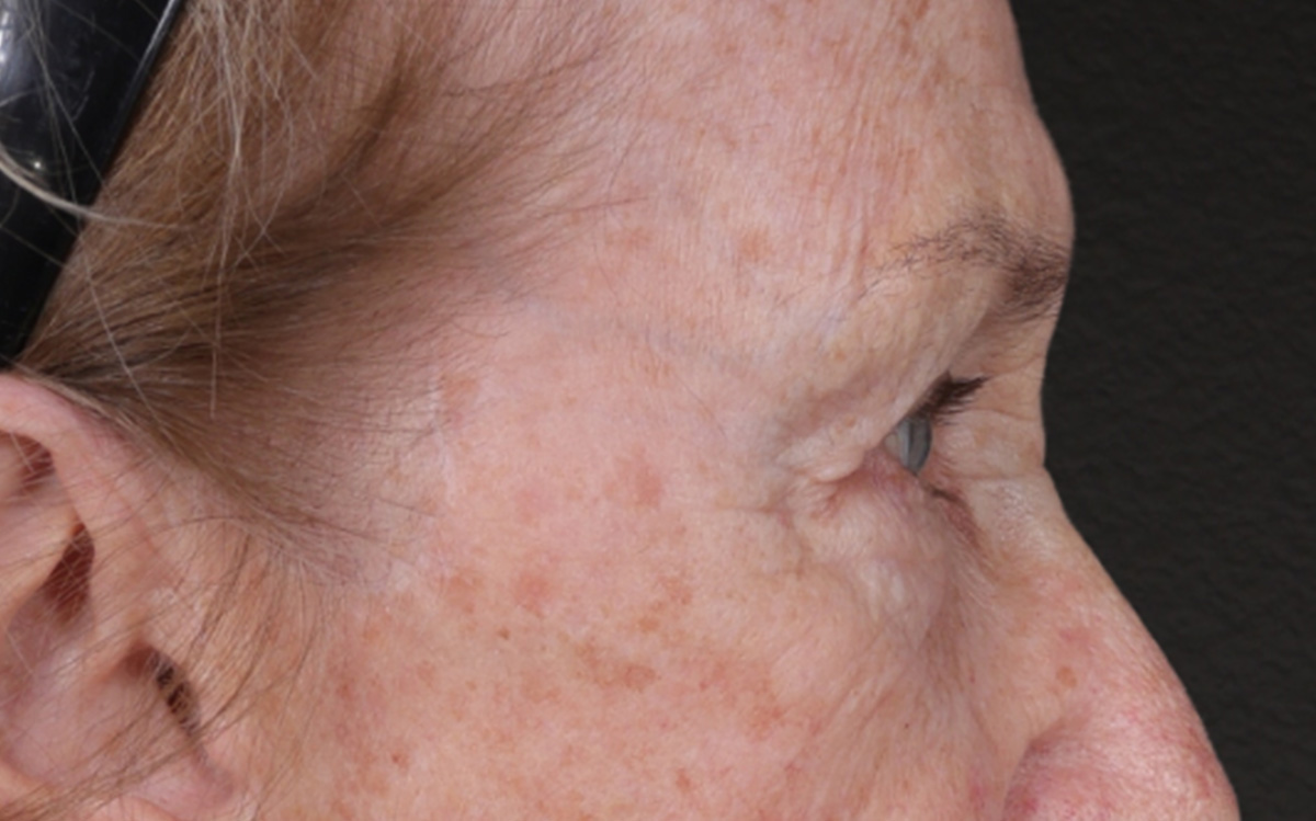Blepharoplasty Before & After Gallery - Patient 162903 - Image 5