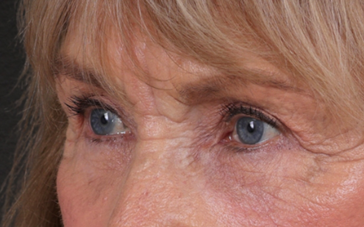 Blepharoplasty Before & After Gallery - Patient 162903 - Image 8