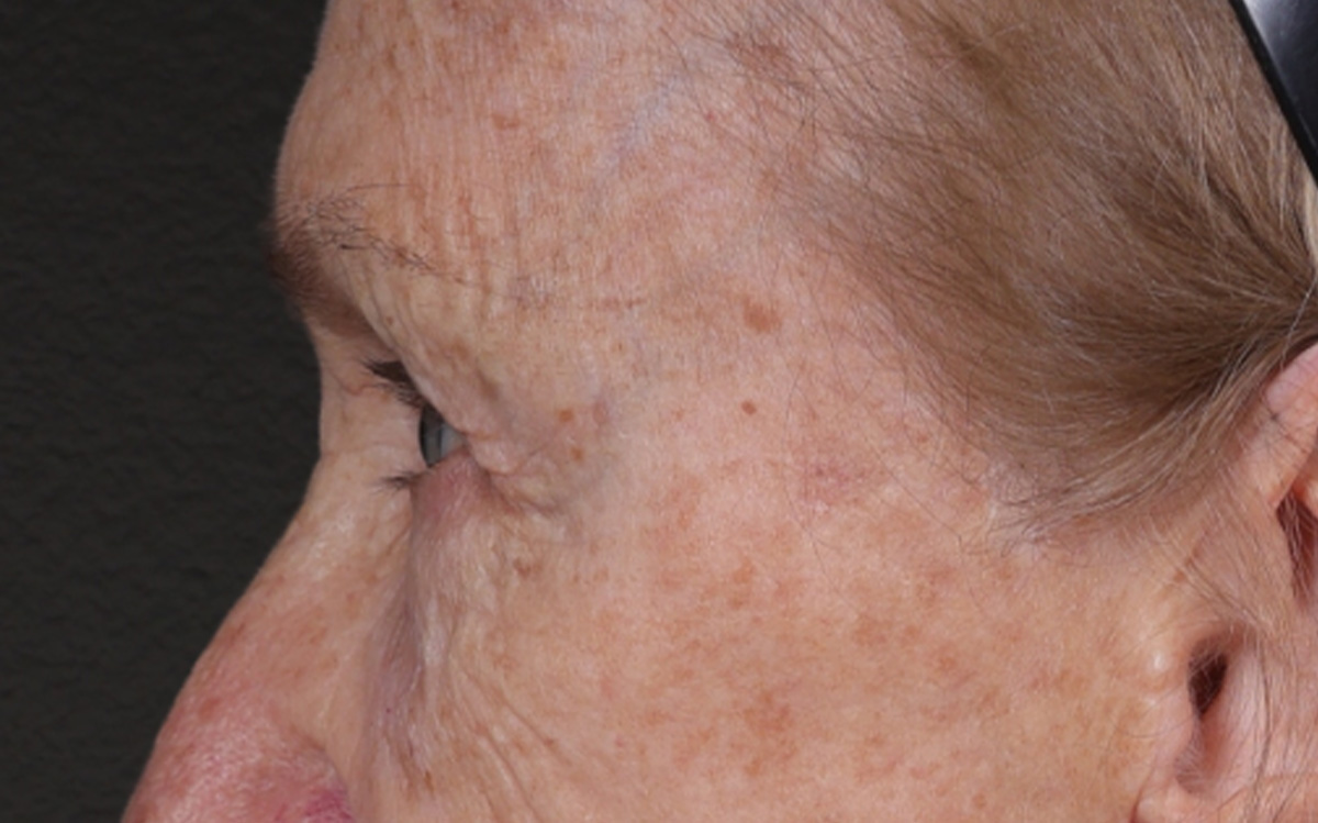 Blepharoplasty Before & After Gallery - Patient 162903 - Image 9
