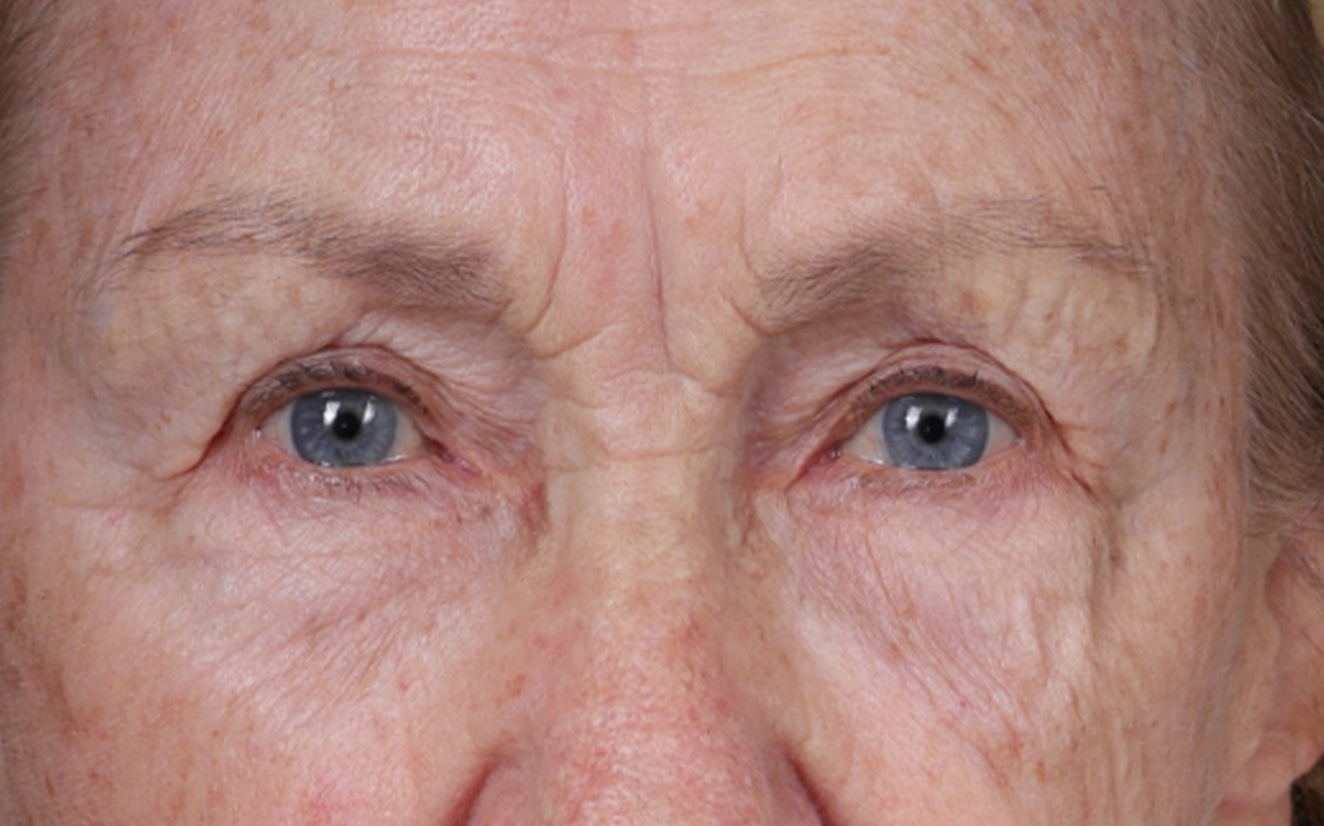 Blepharoplasty Before & After Gallery - Patient 162903 - Image 3