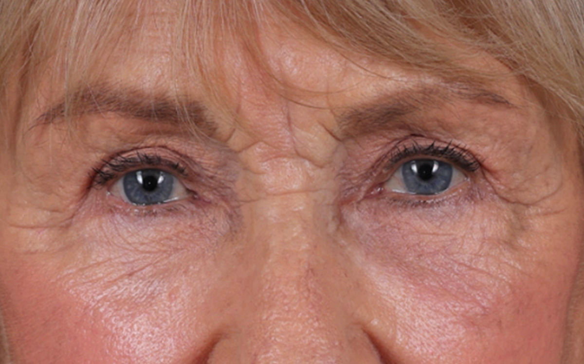 Blepharoplasty Before & After Gallery - Patient 162903 - Image 4